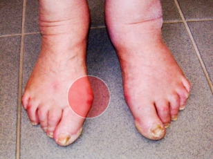 Plantar Fasciitis,Pes Planus,Mallet Toe,High Arched Feet,Heel Spur,Heel Pain,Hammer Toe,Hallux Valgus,Foot Pain,Foot Hard Skin,Foot Conditions,Foot Callous,Flat Feet,Fallen Arches,Diabetic Foot,Contracted Toe,Claw Toe,Bunions Hard Skin,Bunions Callous,Bunion Pain,Ball Of Foot Pain,Back Pain