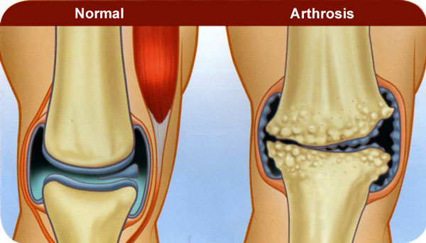 a térdízület arthrosisának súlyosbodása erős fájdalom a jobb könyökízületben