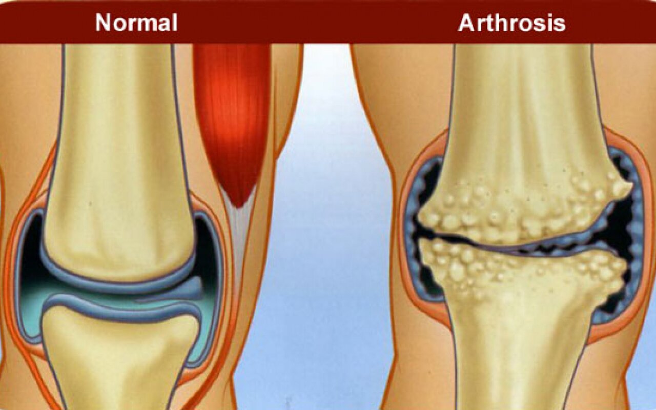 a lábujjak ízületeinek arthrosisának kezelése