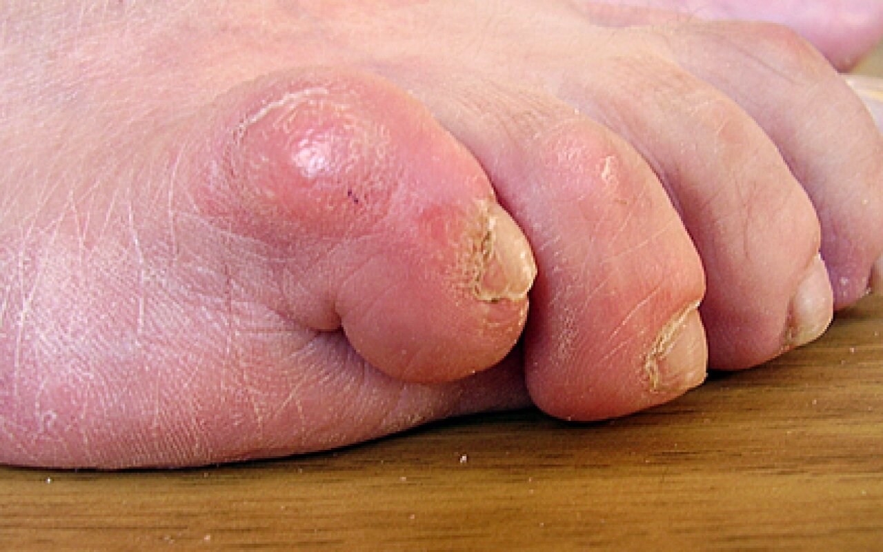 hogyan kezeljük a kis lábujj artrózisát