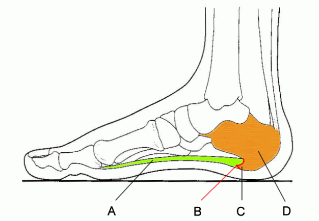 fasciitis-plantaris