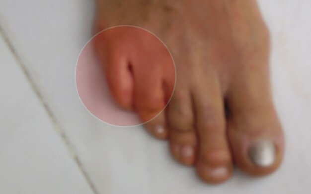 digitus quintus varus