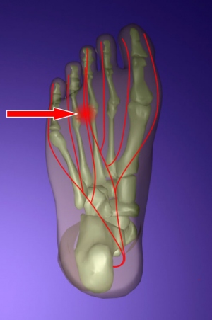 morton-neuroma