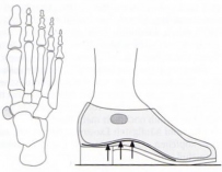 os-naviculare-externum