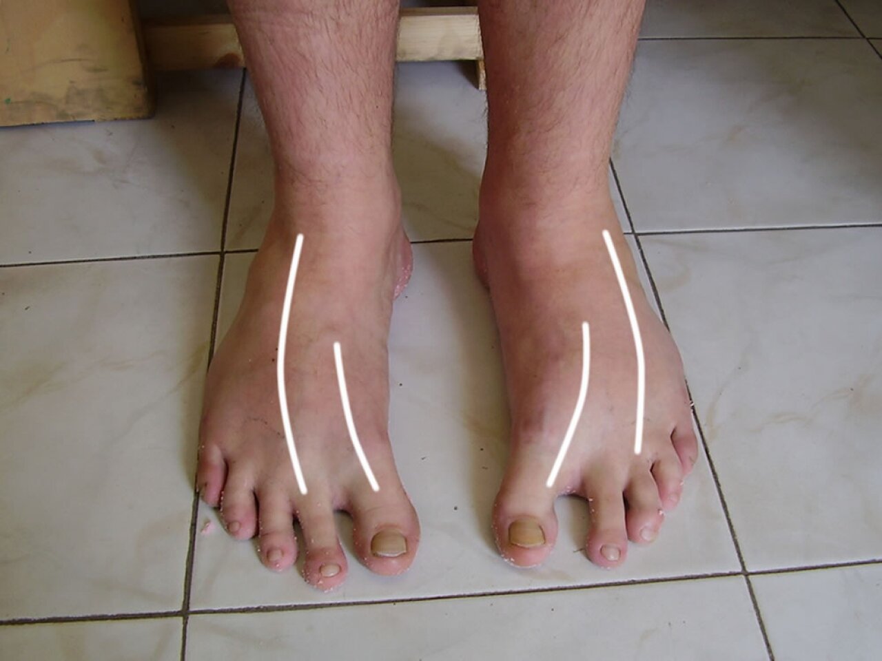 A nagylábujj osteoarthritis helyreállt