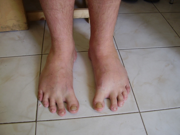 Phalanx distalis hallucis