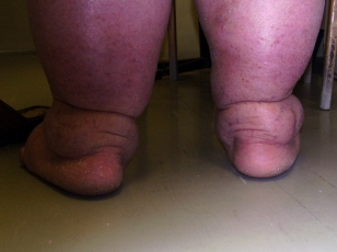 Elefantiasis, Lymphangiectasia