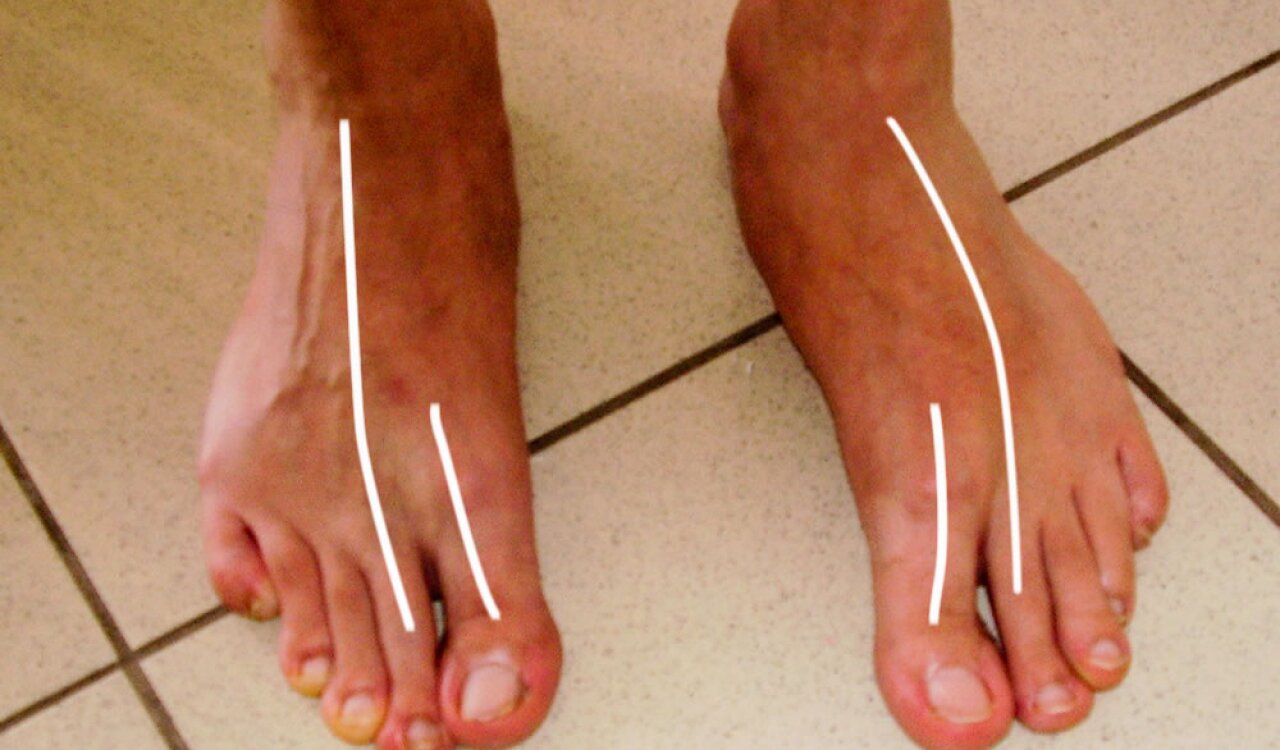 a lábujjak ízületeinek deformációja