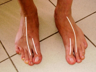 A nagylábujj osteoarthritis helyreállt